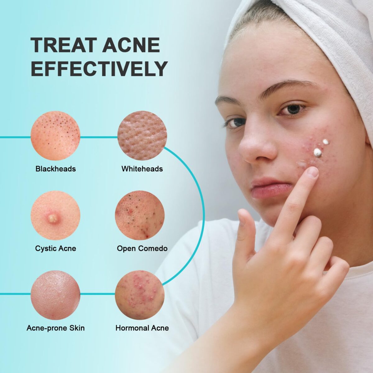 Acne Pimple Spot Treatment Cream: Cystic Hormonal Blackheads Blemish Remover for Face, Back and Body - with 10% Azelaic Acid - Teens 13-19 & Young Adult 20-30, 1.8 oz - Image 3