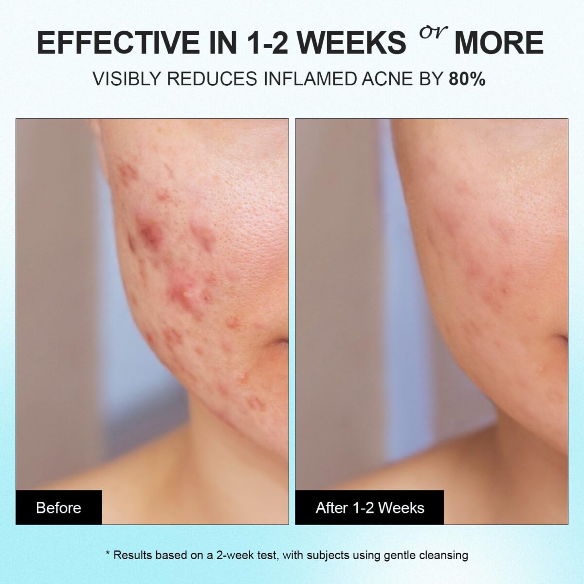Acne Pimple Spot Treatment Cream: Cystic Hormonal Blackheads Blemish Remover for Face, Back and Body - with 10% Azelaic Acid - Teens 13-19 & Young Adult 20-30, 1.8 oz - Image 4