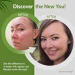 Exposed Skin Care, Acne Treatment Kit with 2.5% Salicylic Acid and 3.5% Benzoyl Peroxide to Clear Up Teen, Adult, Hormonal and Cystic Acne – Natural, Non-toxic and Cruelty Free - Image 4