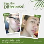 Exposed Skin Care, Acne Treatment Kit with 2.5% Salicylic Acid and 3.5% Benzoyl Peroxide to Clear Up Teen, Adult, Hormonal and Cystic Acne – Natural, Non-toxic and Cruelty Free - Image 5