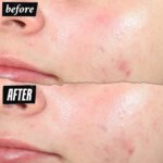 Kiehl's Truly Targeted Acne-Clearing Pimple Patch with 2% Salicylic Acid, Invisible Liquid Spot Treatment, 4% Niacinamide Fades Post-Acne Marks, 0.2% Licorice Root Soothes Redness - 0.5 fl oz - Image 6