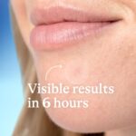 Differin Acne Patches, Pimple Patches for Acne Prone Skin, Formulated with Salicylic Acid and Centella, Fast Triple Action Power Patch for Day & Night, Dermatologist Tested, 36 Count - Image 5