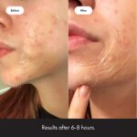 Mighty Patch Surface Large Pimple Patches for Face from Hero Cosmetics, Acne Spot for Body, Cheek, Forehead, and Chin, Pimple Stickers, Hydrocolloid Covers, Vegan-friendly, 10 Count - Image 6