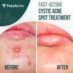 TreeActiv Cystic Acne Spot Treatment, Hormonal & Overnight Sulfur Cystic Treatment For Face, Pimples, and Blemishes for Adults, Men, and Women - 0.5oz 120+ Uses - Image 3