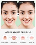 Acne Pimple Patch (180 Counts 4 Sizes), FSA Eligible Invisible Hydrocolloid Acne Patch with Tea Tree Oil & Calendula Oil, Acne Spot Patch Zit Patches for Face - Image 7